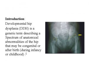 Introduction Developmental hip dysplasia DDH is a generic