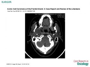 Acinic Cell Carcinoma of the Parotid Gland A