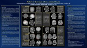 Patterns of Head Injury in Non Accidental Trauma