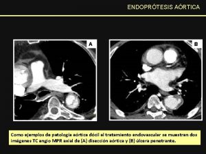 ENDOPRTESIS ARTICA A B Como ejemplos de patologa