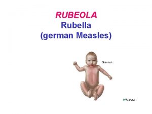 RUBEOLA Rubella german Measles Rubella ETIOLOGIE Virusul rubeolic
