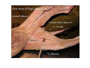 sartorius Gracilis Iliopsoas Gracilis is cut back Adductor