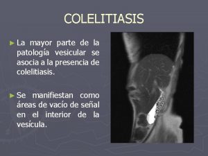 COLELITIASIS La mayor parte de la patologa vesicular