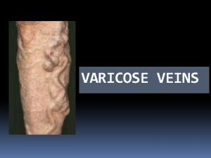 VARICOSE VEINS DEFINITION When a vein becomes dilated