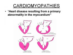 CARDIOMYOPATHIES Heart disease resulting from a primary abnormality