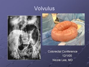 Volvulus Colorectal Conference 12105 Nicole Lee MD Volvulus