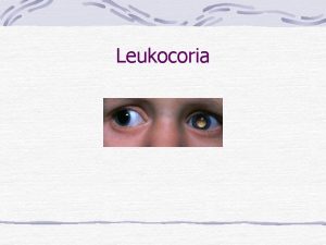 Leukocoria Causes of Leukocoria DIFFERENTIAL DIAGNOSIS OF LEUKOCORIA