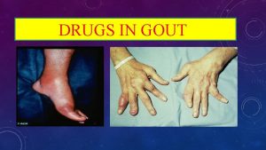 DRUGS IN GOUT ilos Know the pathophysiology of