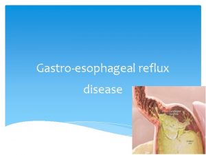 Gastroesophageal reflux disease Key points GERD is a