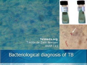 Bacteriological diagnosis of TB Microscopic examination n It
