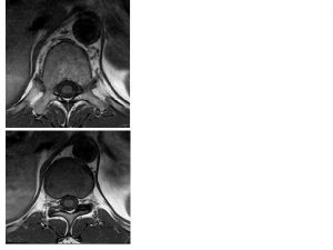 MRI of the Thoracic Spine Axial T 1