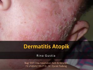 Dermatitis Atopik Rina Gustia Bag SMF Ilmu Kesehatan