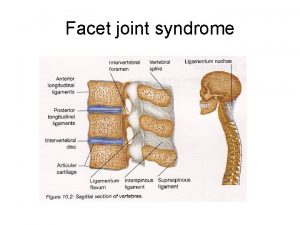 Facet joint syndrome Facet joint syndrome Libndin milli