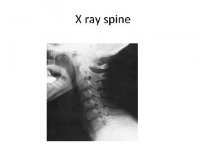 X ray spine SPINE TRAUMA CERVICAL SPINE INJURY