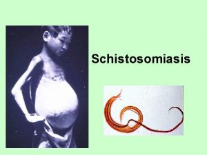 Schistosomiasis Schistosomiasis also known as bilharzia bilharziosis or