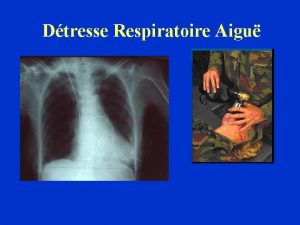 Dtresse Respiratoire Aigu Dfinition La dtresse respiratoire apparat