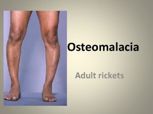 Osteomalacia Adult rickets Word Meaning Greek origin Osteo