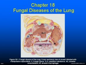 Chapter 18 Fungal Diseases of the Lung YLS