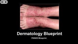 Dermatology Blueprint PANCE Blueprint Eczematous Eruptions Contact Dermatitis