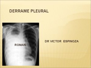 DERRAME PLEURAL DR VICTOR ESPINOZA ROMAN DERRAME PLEURAL