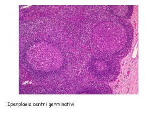 Iperplasia centri germinativi Linfoma nodulare Tumore benigno Anaplasia