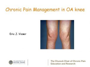 Chronic Pain Management in OA knee Eric J
