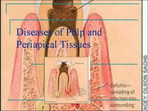 Diseases of Pulp and Periapical Tissues Diseases of