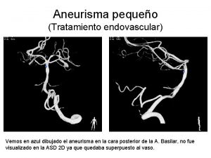 Aneurisma pequeo Tratamiento endovascular Vemos en azul dibujado