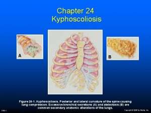 Chapter 24 Kyphoscoliosis A Slide 1 B Figure