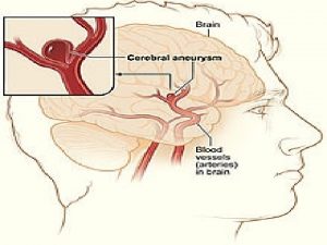 ANTERIOR COMMUNICATING ANEURYSMS DR M ABBASZADEH NEUROSURGEON RAZI