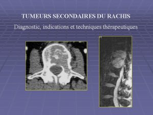 TUMEURS SECONDAIRES DU RACHIS Diagnostic indications et techniques