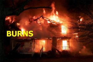 BURNS Burn Injury Tissue destruction can lead to