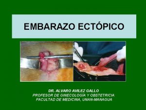 EMBARAZO ECTPICO DR ALVARO AVILEZ GALLO PROFESOR DE