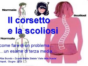 Il corsetto e la scoliosi come fare di