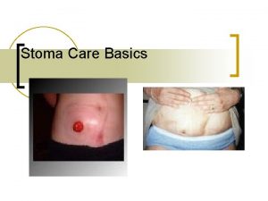 Stoma Care Basics Two basic types of diversions