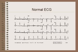 Normal ECG normal sinus rhythm o o o