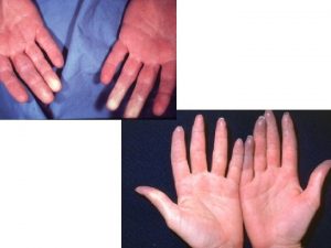 1 Functional vascular disorders Raynauds phenomenon 2 Raynauds