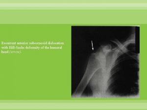 Recurrent anterior subcoracoid dislocation with HillSachs deformity of