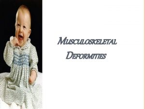MUSCULOSKELETAL DEFORMITIES OUT LINES Polydactyly syndyctyly Limb reduction