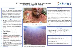 A Crusting Case of Atypical Systemic Lupus Erythematosus