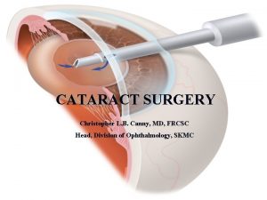 CATARACT SURGERY Christopher L B Canny MD FRCSC