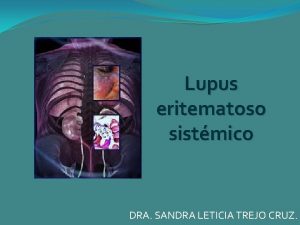 Lupus eritematoso sistmico DRA SANDRA LETICIA TREJO CRUZ