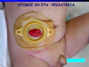 GASTROSTOMIE ILEOSTOMIE COLOSTOMIE PEG PEG Assistenza al paziente