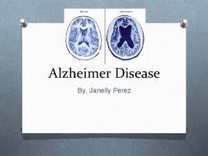 Alzheimer Disease By Janelly Perez What is Alzheimers