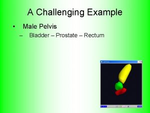 A Challenging Example Male Pelvis Bladder Prostate Rectum