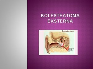 KOLESTEATOMA EKSTERNA Kolesteatoma adalah suatu kista epitelial yang