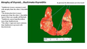 Atrophy of thyroid Hashimoto thyroiditis Hashimoto is more
