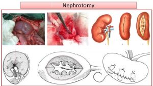 Nephrotomy Nephrotomy usually is performed to remove calculi