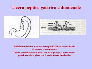 Ulcera peptica gastrica e duodenale Definizione lesione escavativa