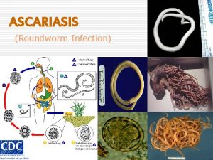 ASCARIASIS Roundworm Infection Definition Infection caused by parasite